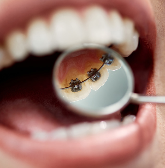 Lingual braces Lingual braces