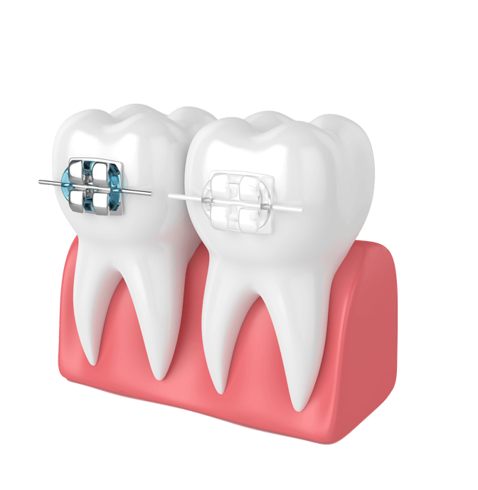 How do braces work?