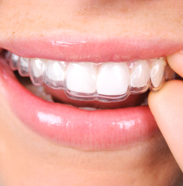 Invisalign® treatments in Bury Invisalign® treatments in Bury